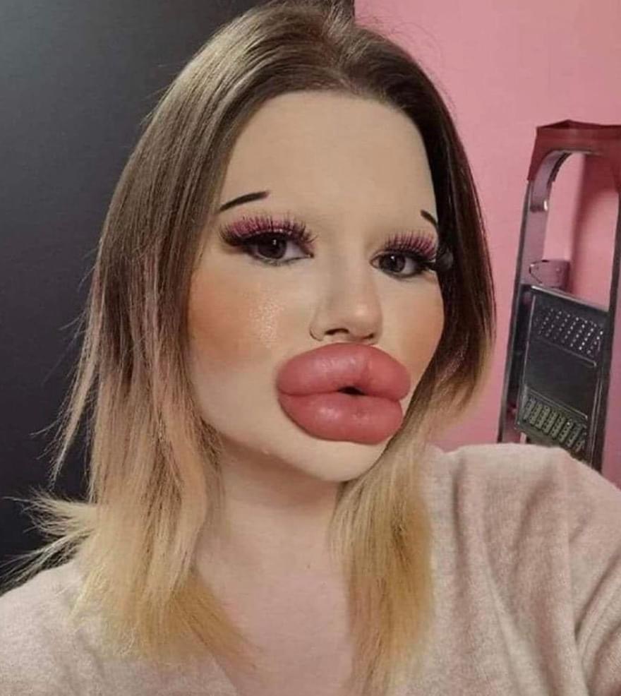 24-year-old woman with ‘biggest lips’ in the world has spent $5,000 on fillers and still wants to go BIGGER